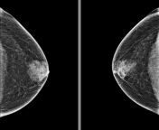 Mammogram Images of my Budding Little Tiddies. Currently, 2mg e2 Tablets Sublingual and 50mg Spiro from tablets