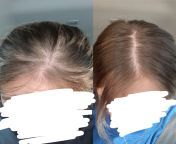 I do not necessarily have trichotillomania, but I pull off my split ends which has resulted in accidentally pulling out hair. Over the past year I have noticed Im balding in different areas all over. I finally have FORCED myself to stop, after 10 years o from cmnf in military areas