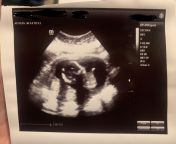 Any help in determining sex in ultrasound? from stepmom help son hard sex
