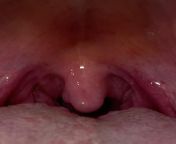 Small lump on uvula. Just noticed it this morning. Ive had a cold for a couple days now but didnt notice it prior. Could it be related to that? from lump com