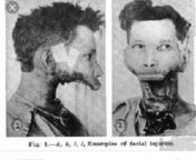 Seriously, WTF??? True Story of Man (Eben Byer) Who Loses Half of His Jaw Due To Years of Radiation Consumption from wtf pass commil amma fuck