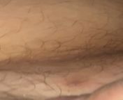 Quick pop from an ingrown Ive been struggling with on my pubic area. NSFW tagged Bc of location but you cant tell what it is on video from but it is excluded video
