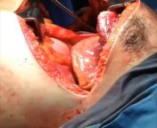 Emergency thoracotomy with open chest cardiac massage for non-traumatic cardiac arrest. accompanied with an intracardiac injection of Adrenalin (epinephrin) directly into the heart muscle. from cardiac