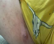 i posted a while ago when this bad boy appeared and its finally decided to empty itself (NSFW inner thigh) from ssbbw atl bad boy azzom and son hindi chudai sex 3gp vide