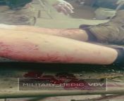Ru Pov Graphic video of a Russian soldier with a buttock wound getting it packed with gauze from russian school ru