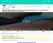 Absolutely disgusting video of an extreme case of myiasis in a patient with diabetic foot.. credit to u/GiorgioMD from telugu porn video of an orthodox housewife mp4
