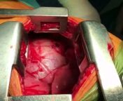 Doctors removing a knife that just missed the heart. It actually pierced the membrane of the heart wall. Very lucky. Warning: Open-heart surgery. from wthÃÂ± is the heart gameplay