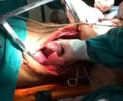 Open cardiac massage and resuscitation with thoracotomy from cardiac