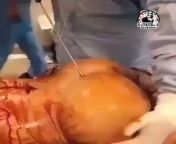 [Plastic surgery] In the video you can see lipofilling - a procedure that involves injecting your own adipose tissue taken from other areas under the skin of the buttocks. from secret camera sex video taken from studio mp4