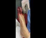 Stage V infected gangrene diabetic foot. from v v v