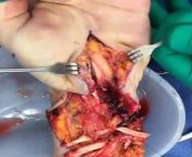 This was an accidental work-related injury in a young man sustaining a significant injury to most major structures in his wrist including vasculature, tendons, nerves, and muscle. from this was strangely attractive mp4